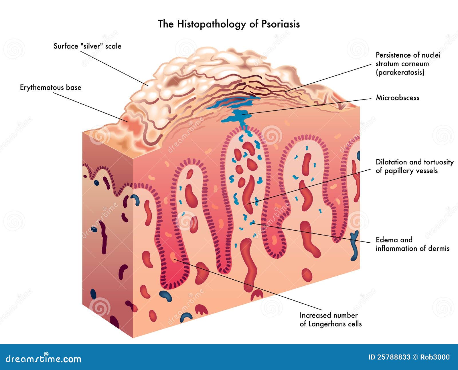 psoriasis