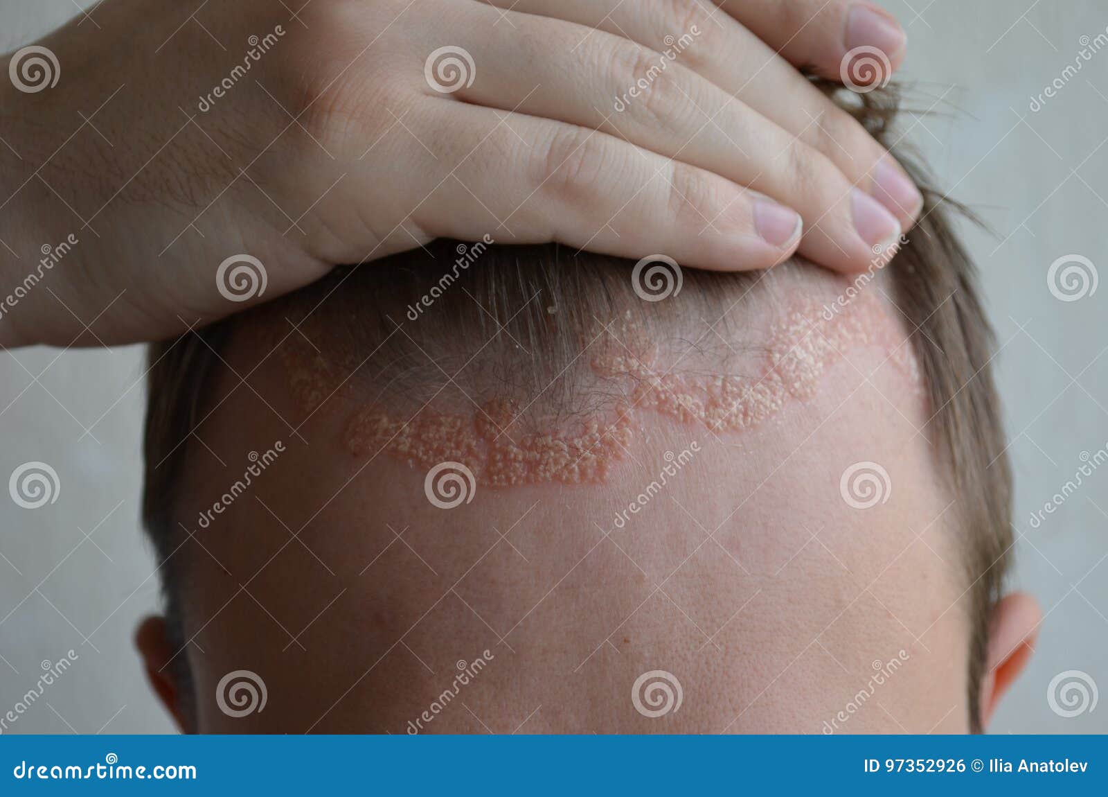 Psoriasis Auf Der Hautnahaufnahme Kopfhaut Fotos Der Dermatitis Und Ekzem Hautprobleme Dermatologie Stockfoto Bild Von Dermatologie Psoriasis