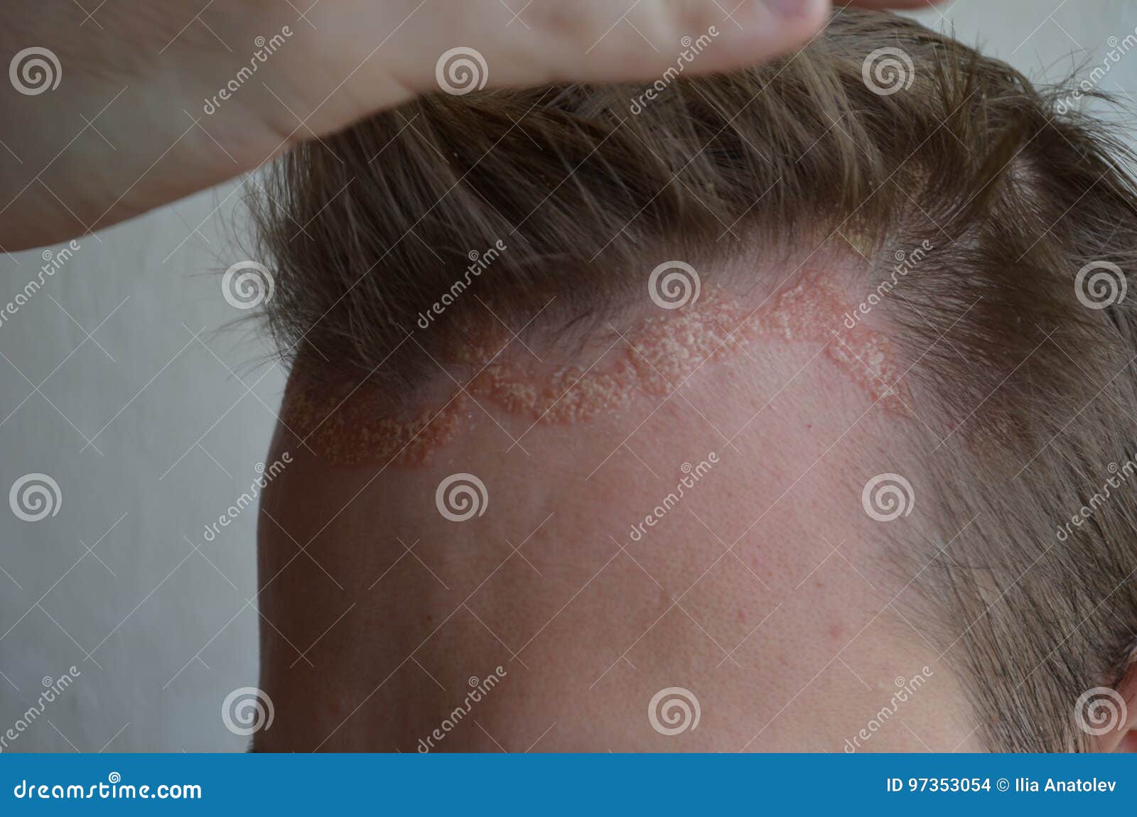 Psoriasis Auf Der Hautnahaufnahme Kopfhaut Fotos Der Dermatitis Und Ekzem Hautprobleme Dermatologie Stockfoto Bild Von Hautnahaufnahme Kopfhaut