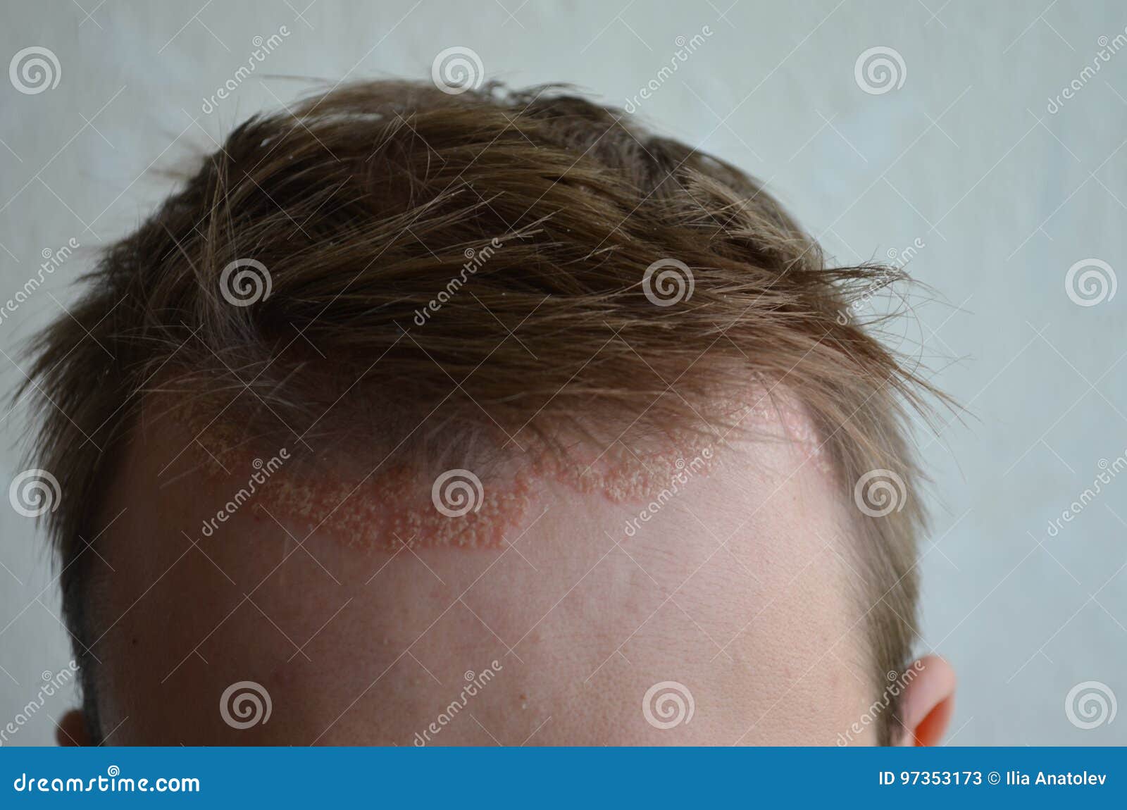 Psoriasis Auf Der Hautnahaufnahme Kopfhaut Fotos Der Dermatitis Und Ekzem Hautprobleme Dermatologie Stockbild Bild Von Hautprobleme Dermatologie