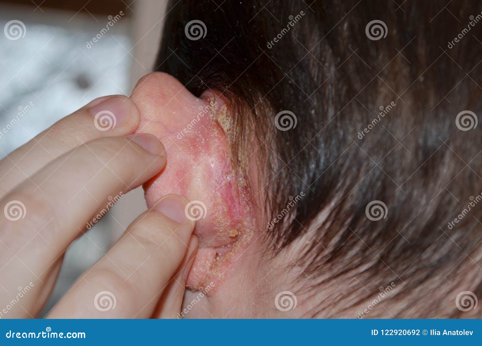 psoriasis behind ears weeping)