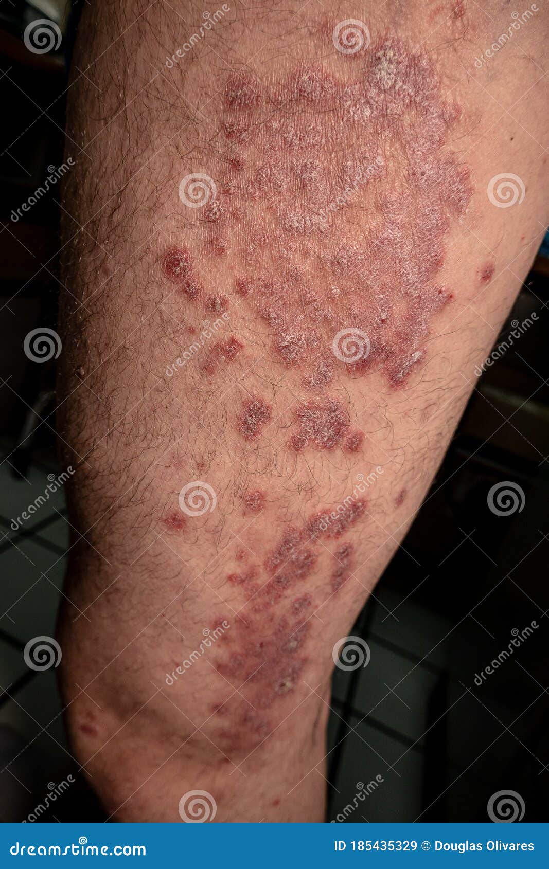 is psoriasis a chronic inflammatory disease