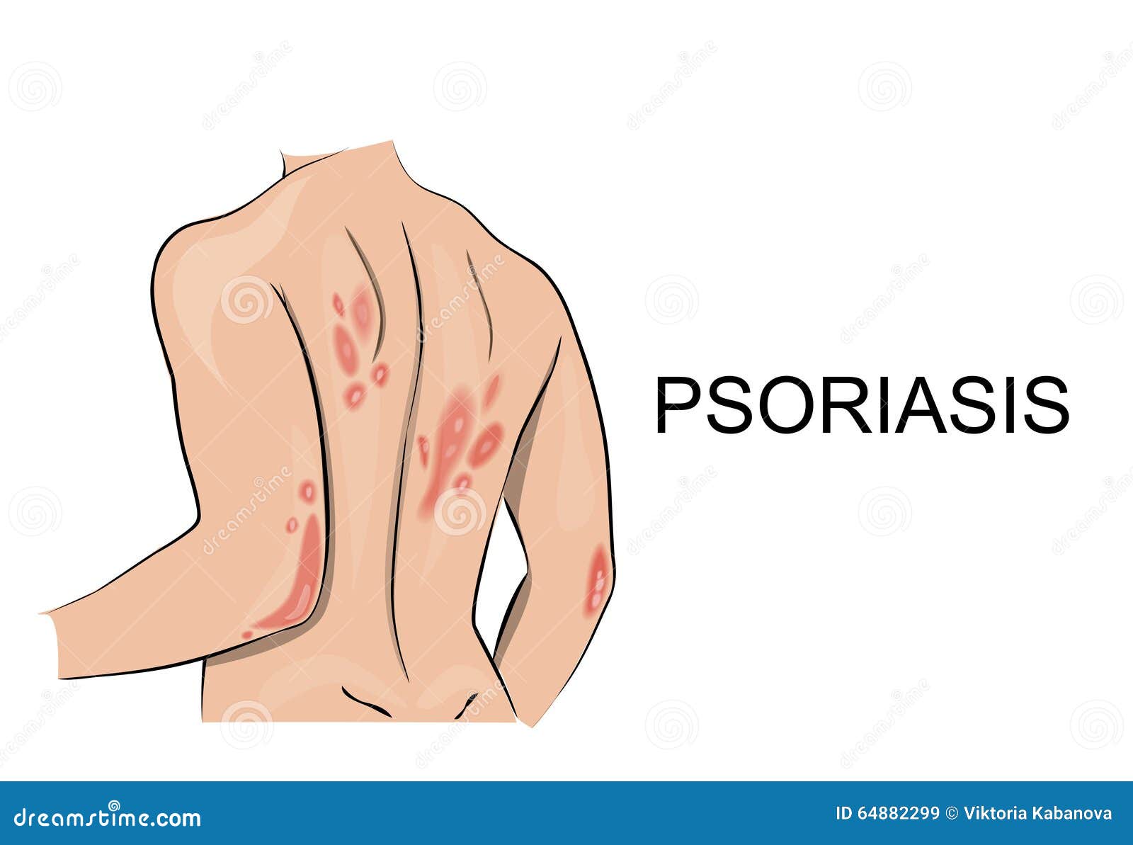 psoriasis. dermatology. allergy.