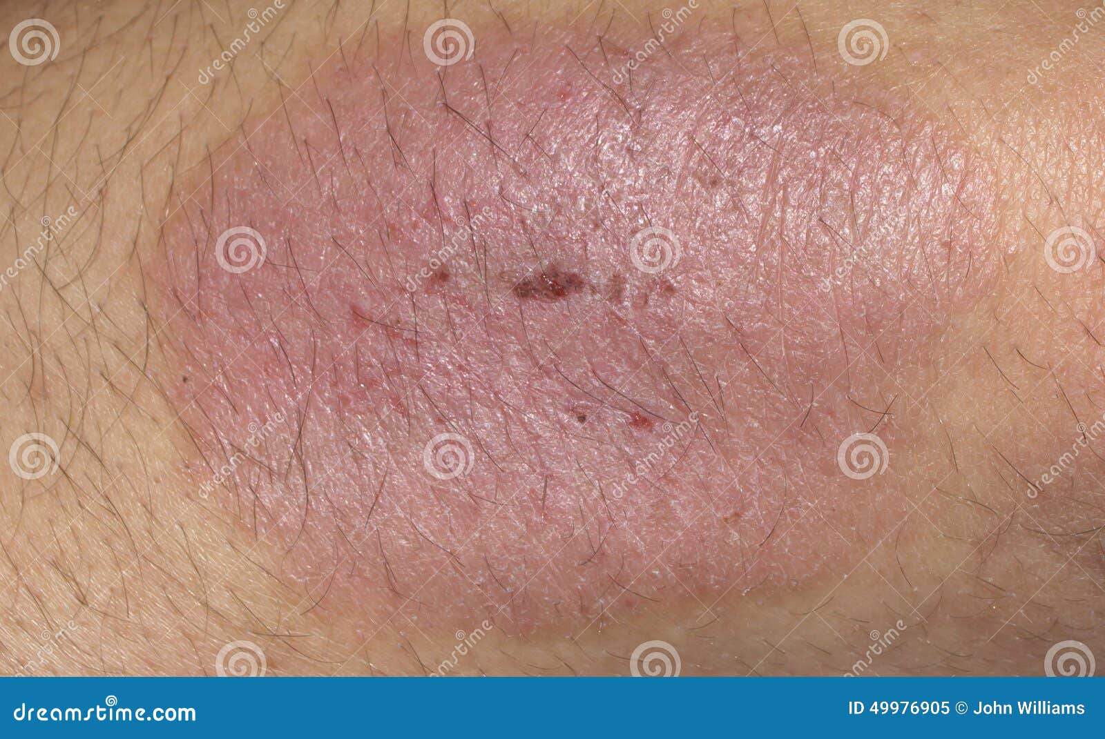 Psoriasis Stock Image Image Of Elbow Patient Common 49976905