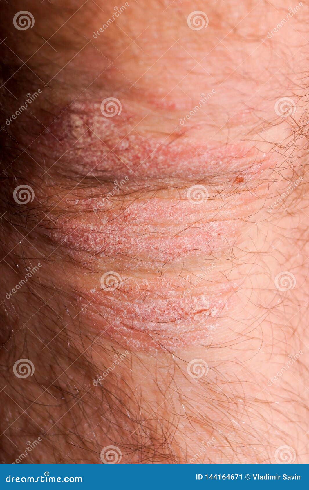 Psoriasis Dry Red And White Irritation On The Skin Closeup Stock Image