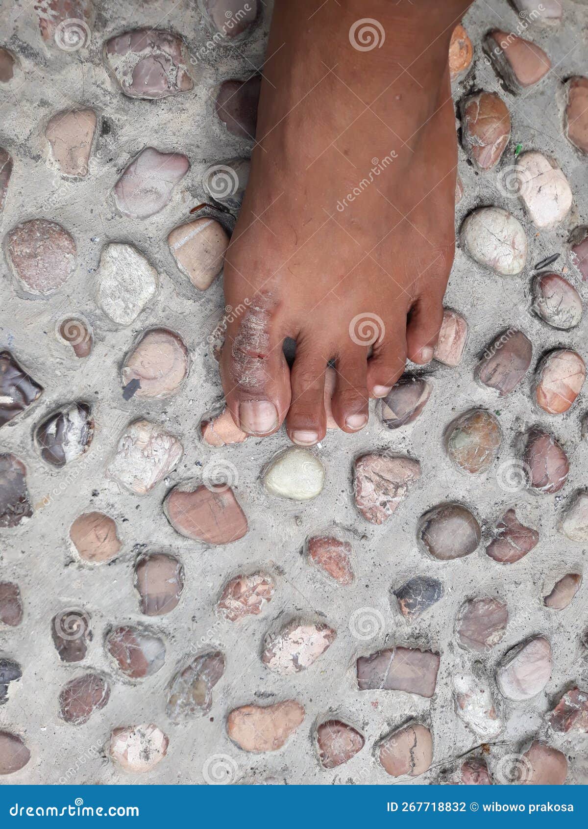 Psoriasis Eczema Dermatitis on the Big Toe Stock Photo Image of