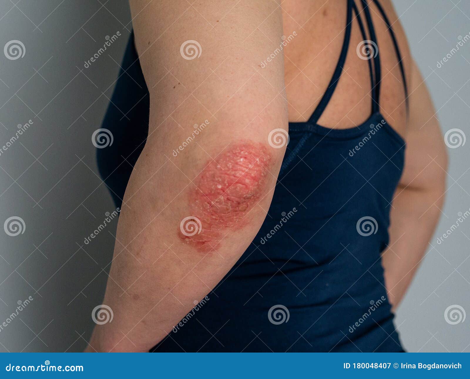 Psoriasis On Elbow Isolated Closeup Of Rash And Scaling On The