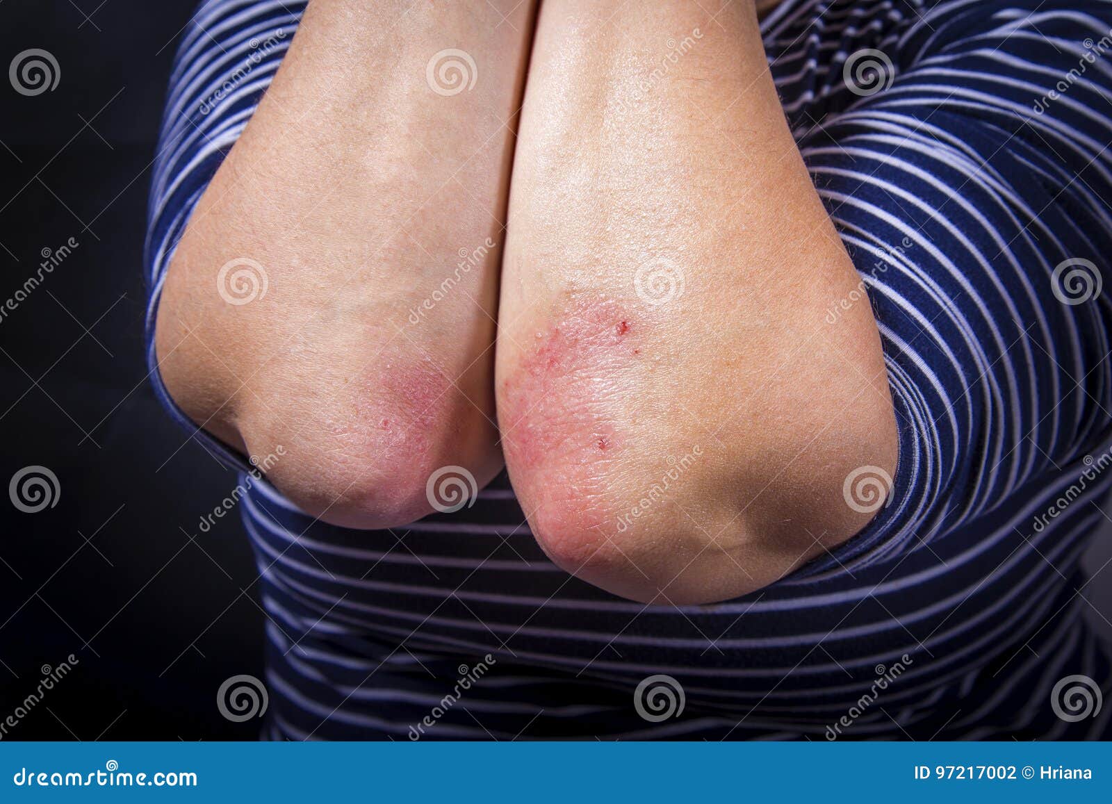 psoriasis on elbow