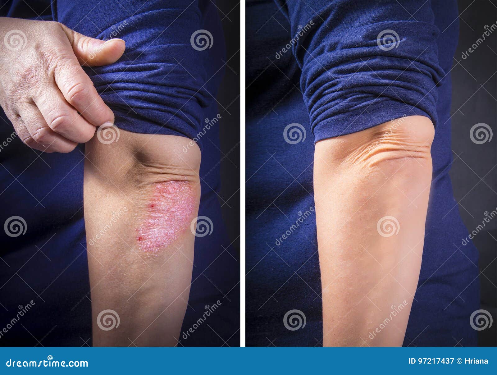 Psoriasis on Elbow before and after Stock Image Image of care