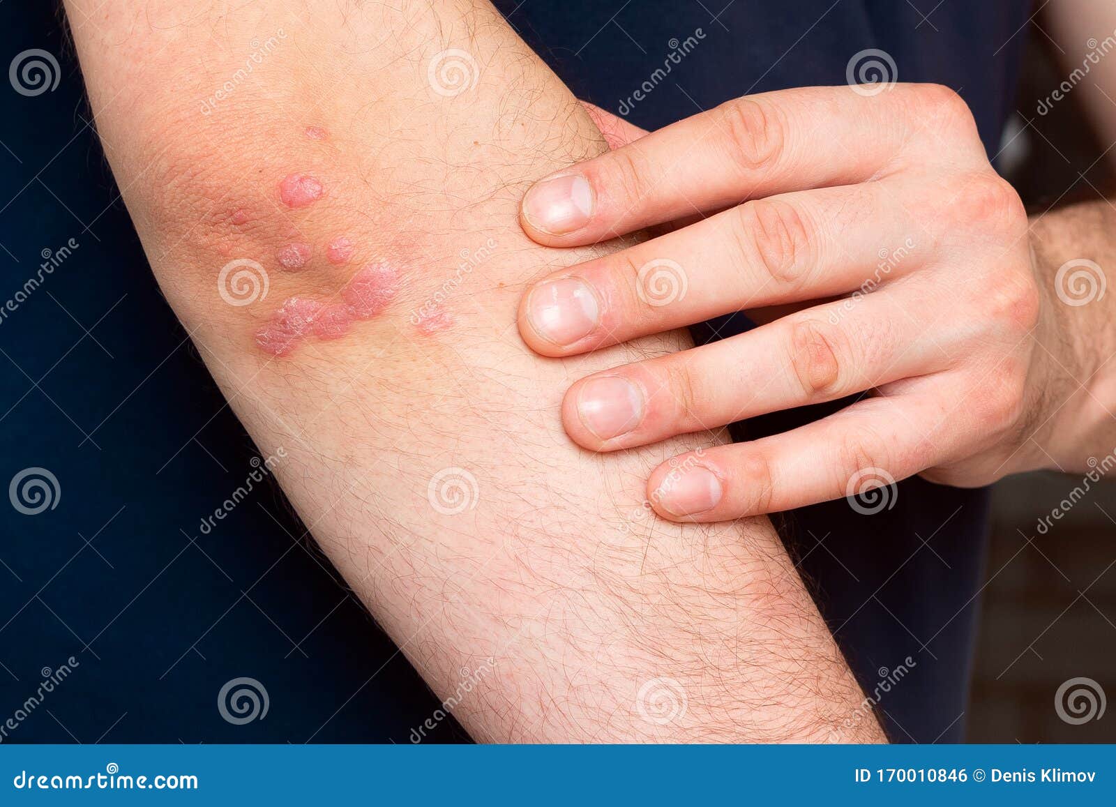 psoriasis painful elbows)