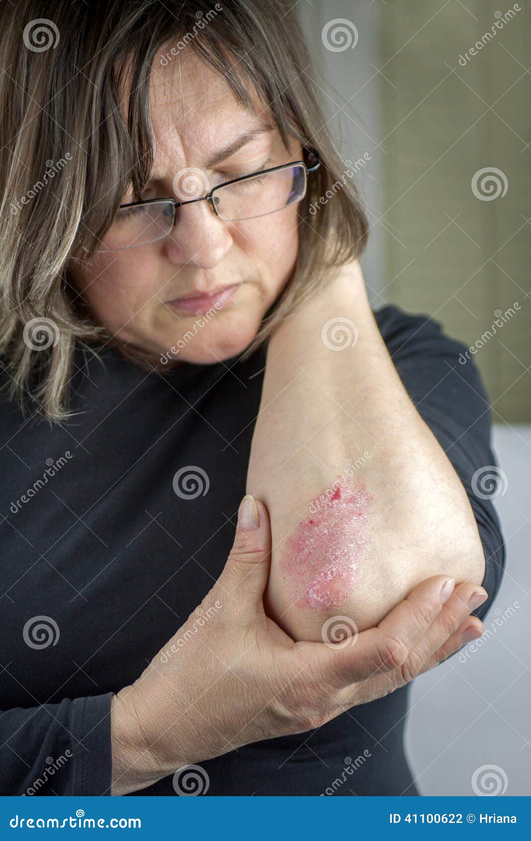 psoriasis on elbow