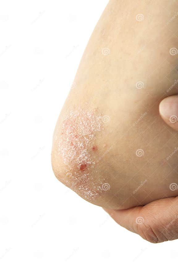 Psoriasis On Elbows Stock Photo Image Of Disease Itchy 41100172