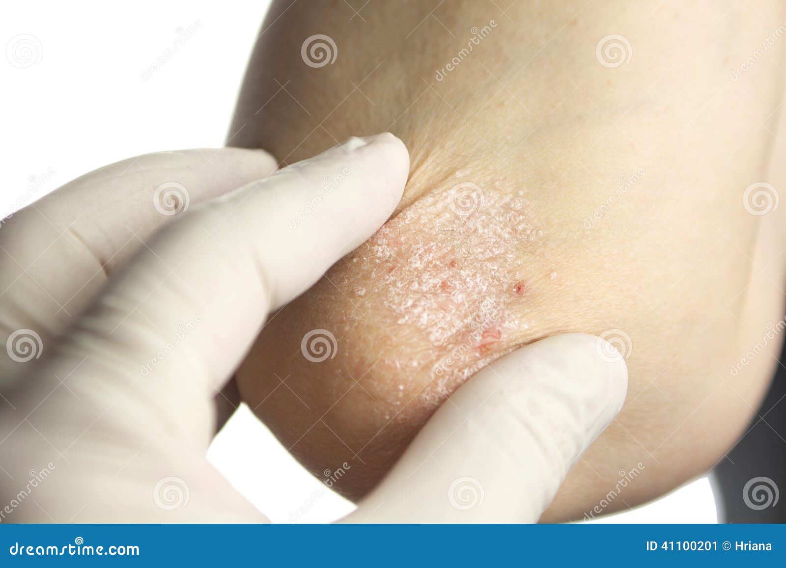 Psoriasis On Elbows Stock Photo 41100378