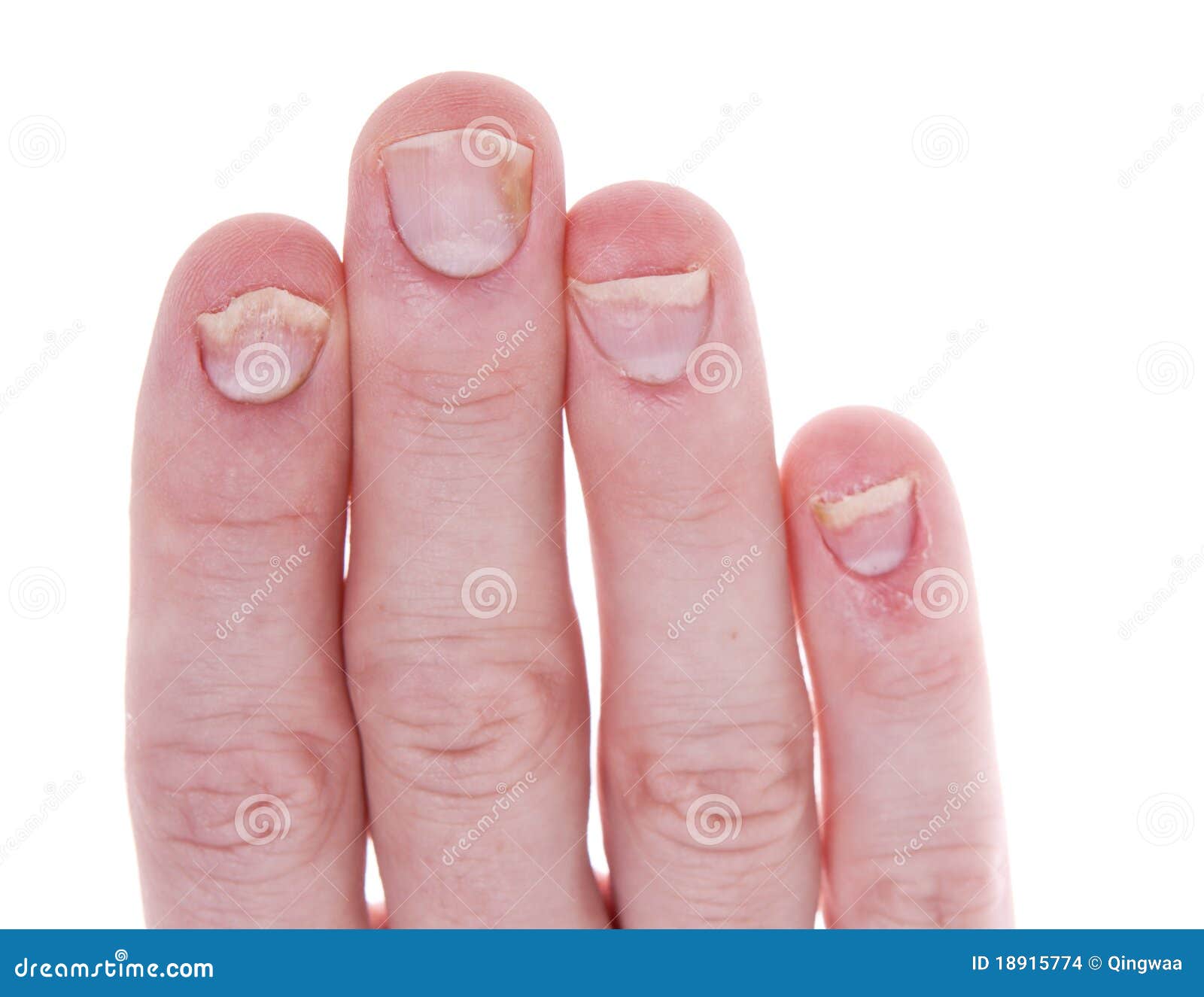 CosmeStyles Sensation - Common Nail Problems? How to get rid all of them?  Find how! :) Nail problems affect people of all ages. Diet is generally not  responsible for abnormal nail changes,