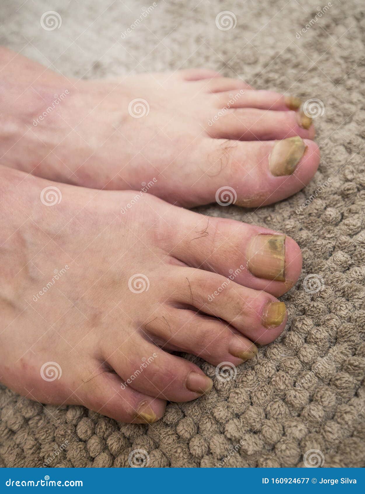 Psoriasis in the foot stock image. Image of healthcare 160924677