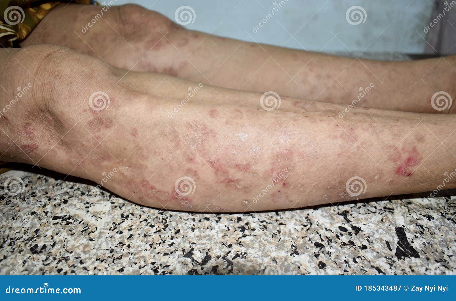 Psoriasis or Fungal Infection Called Tinea Corporis on Leg of