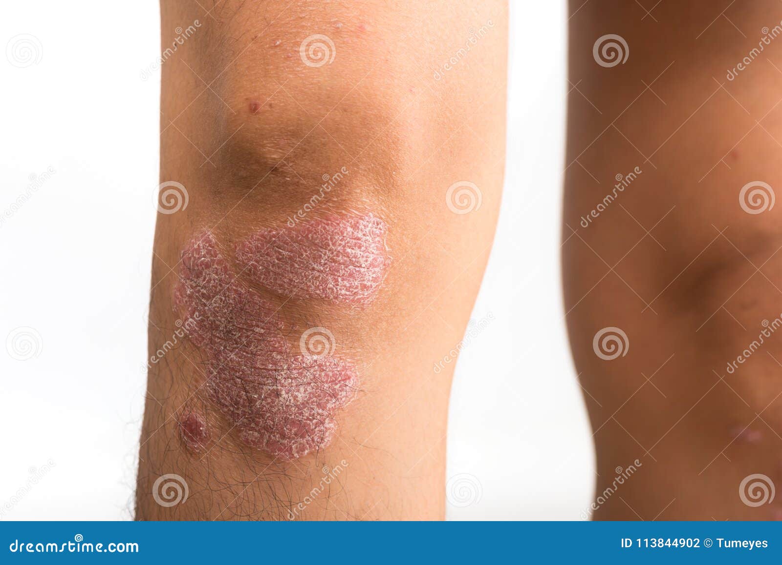 psoriasis that knee