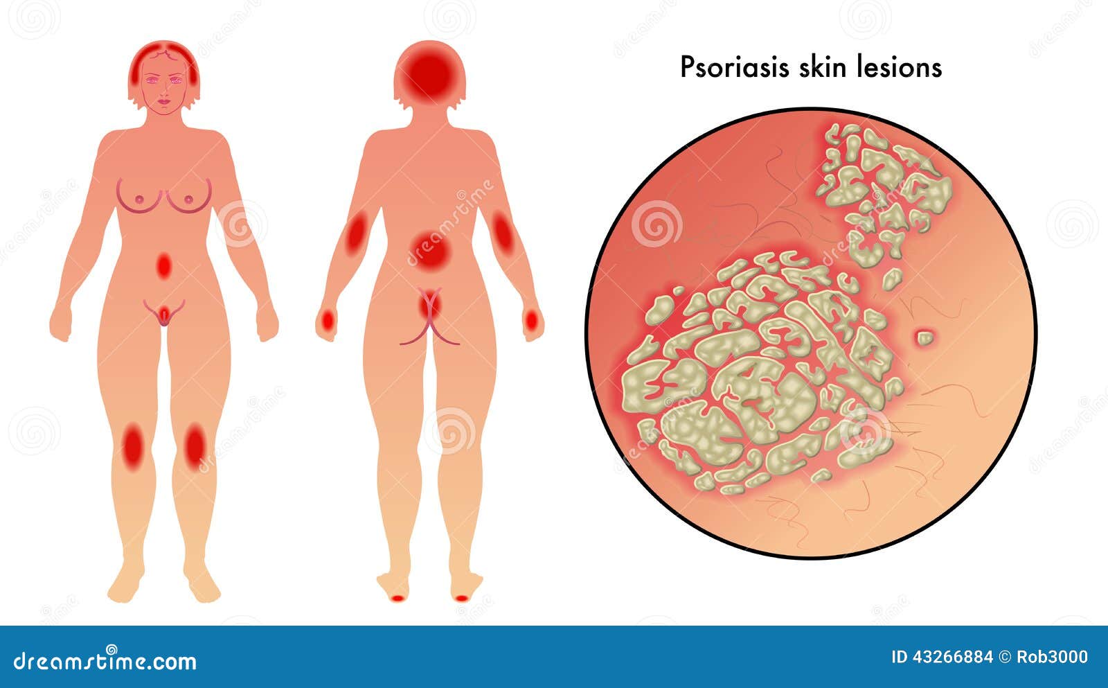 psoriasis