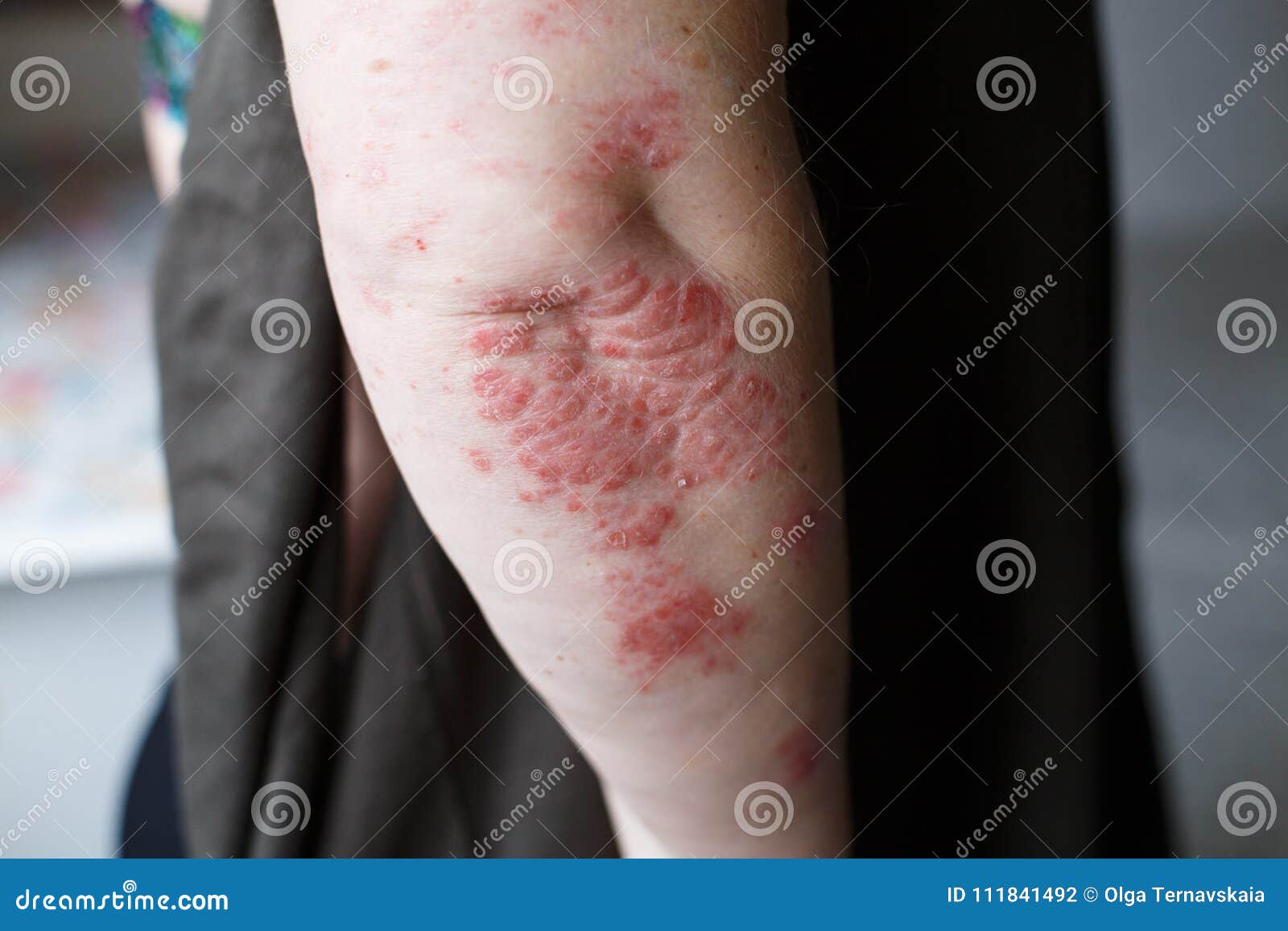 autoimmune psoriasis eczema)