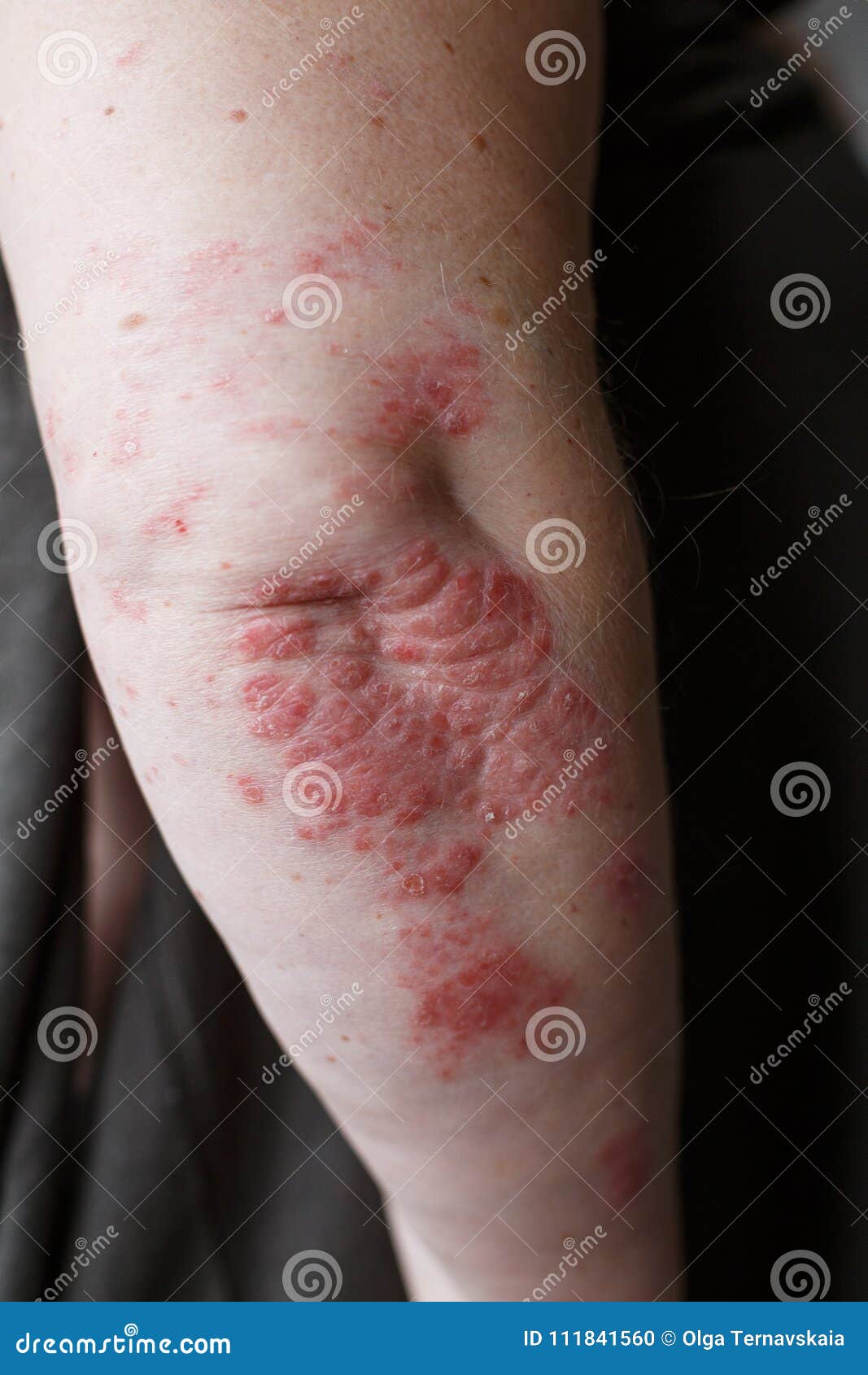 Psoriasis Skin Psoriasis Is An Autoimmune Disease That Affects The