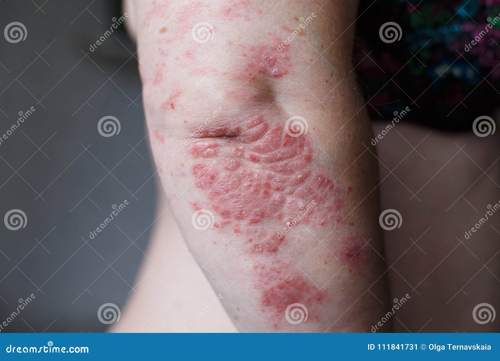 Department of Immunology and Biotechnology · Subjects · Immunology of the Skin · UP MS