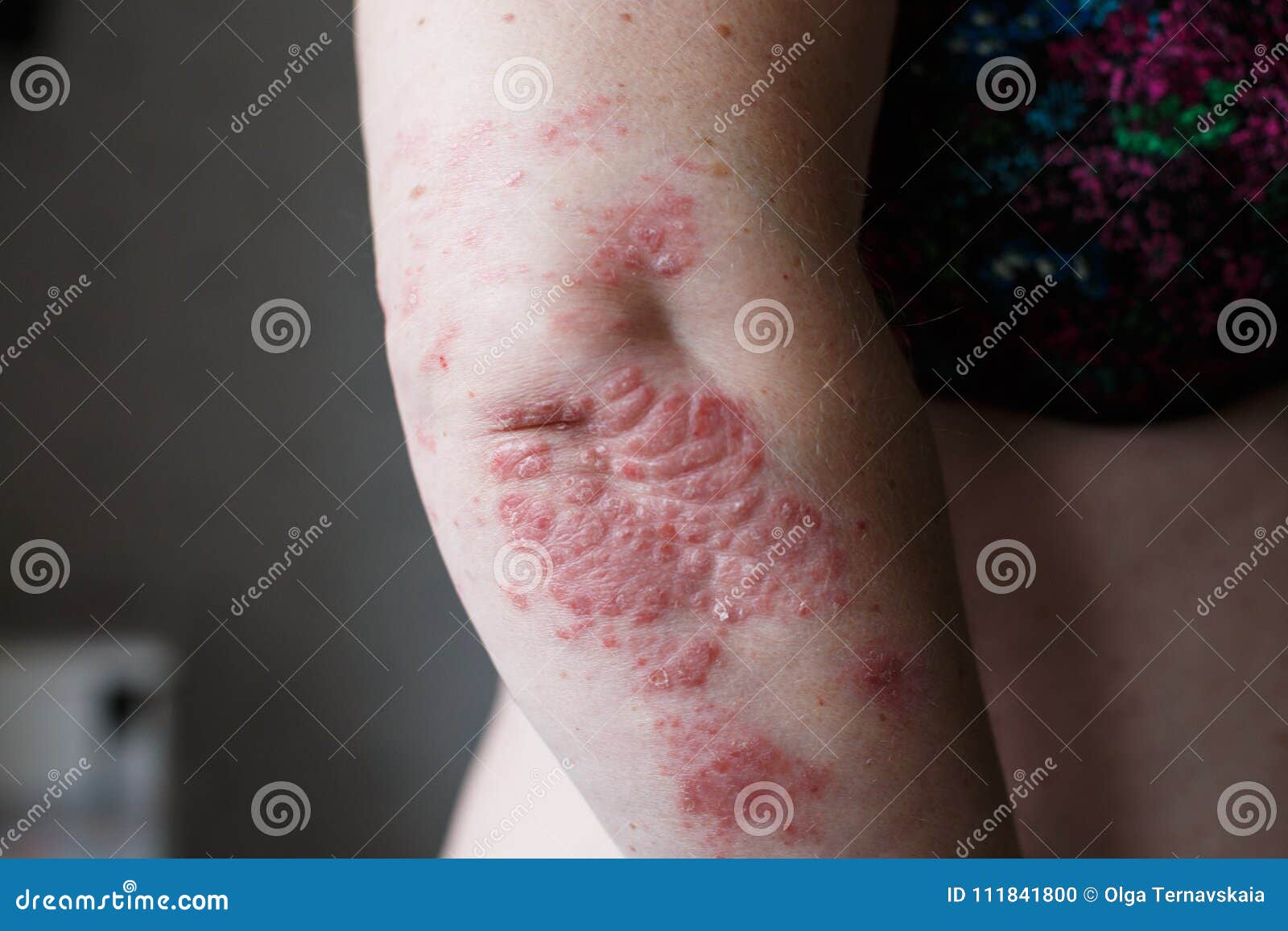 autoimmune psoriasis eczema