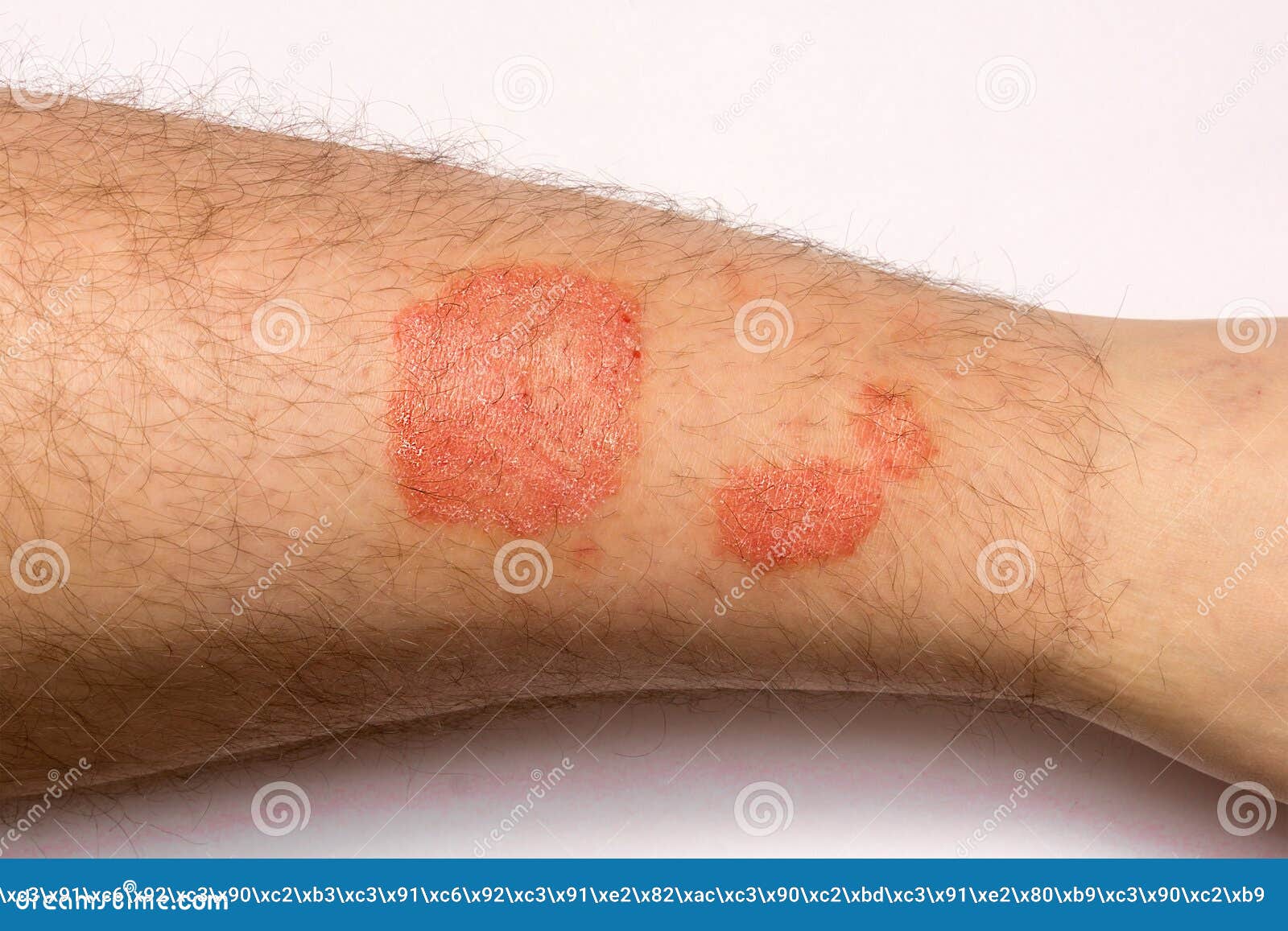 Psoriasis Skin Disease Stock Photo 93260718