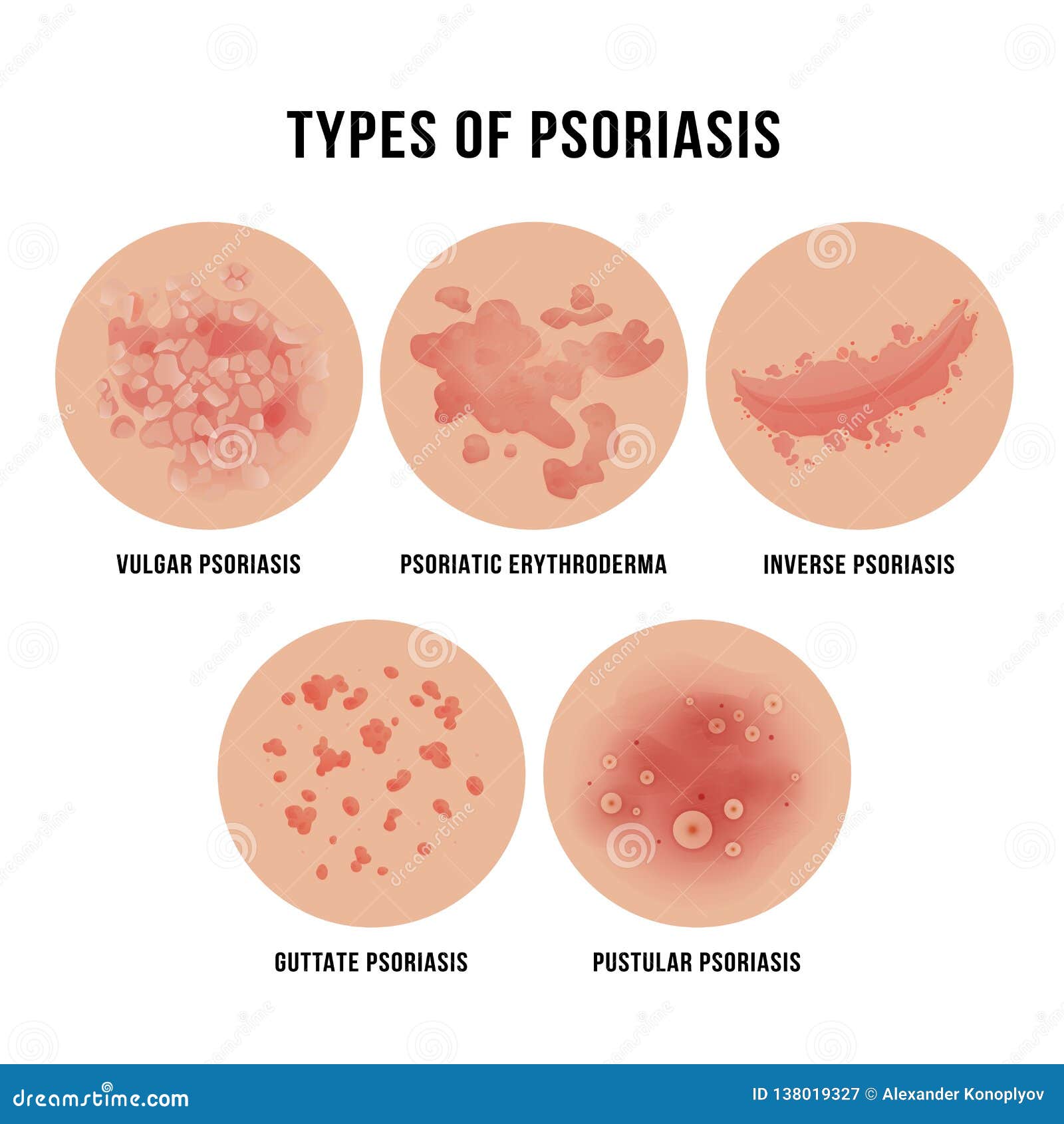 types of psoriasis skin condition