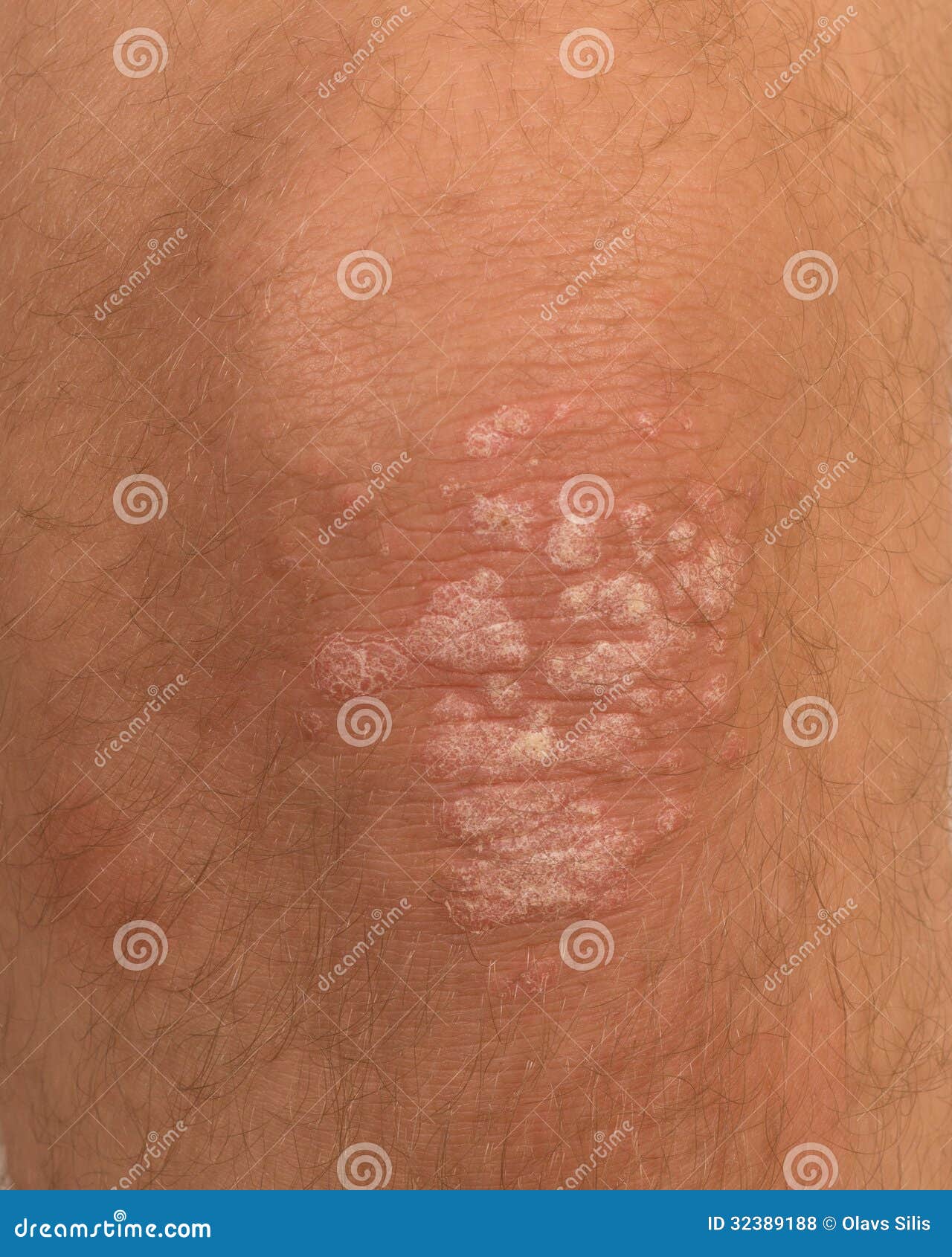 Psoriasis Stock Photo Image Of Eczema Closeup Dermatitis 32389188