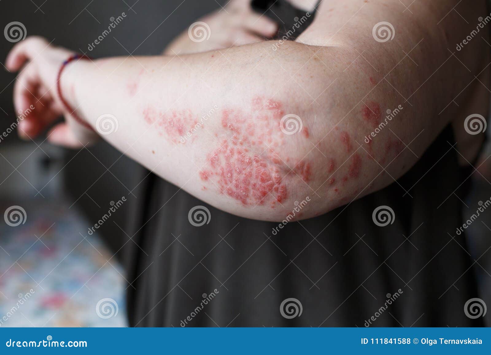 is skin psoriasis an autoimmune disease)
