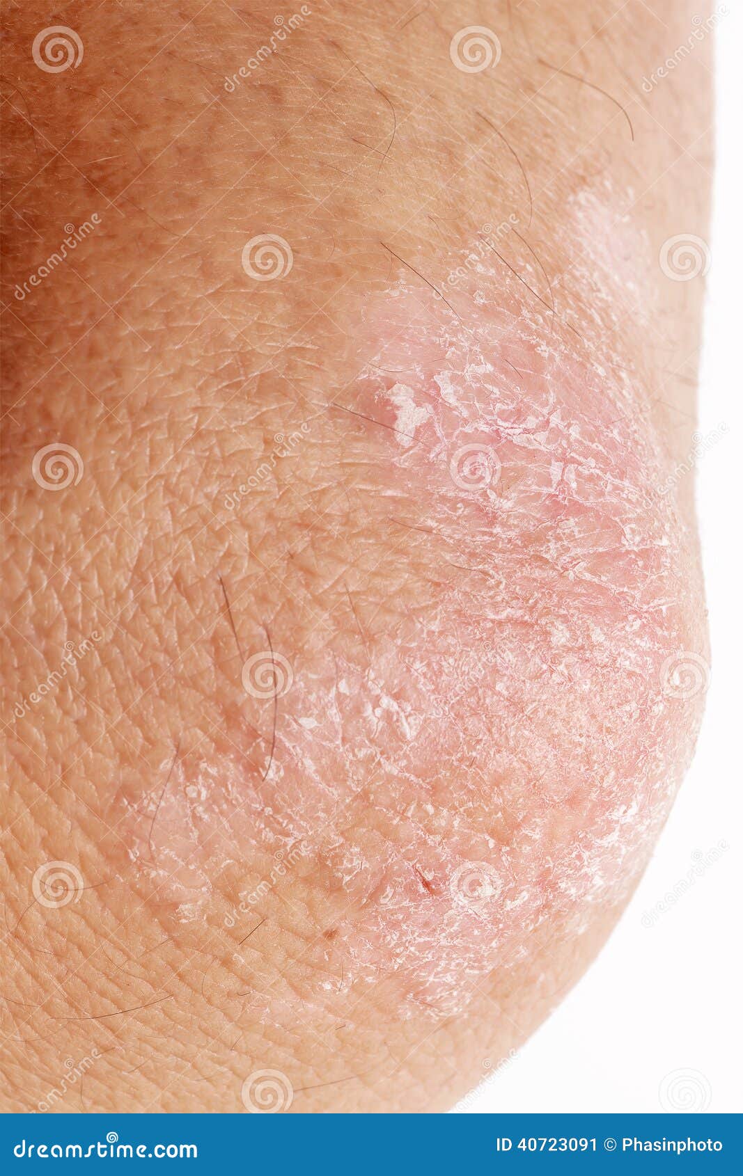Psoriasis sur le coude image stock. Image du dermatologie 40723091