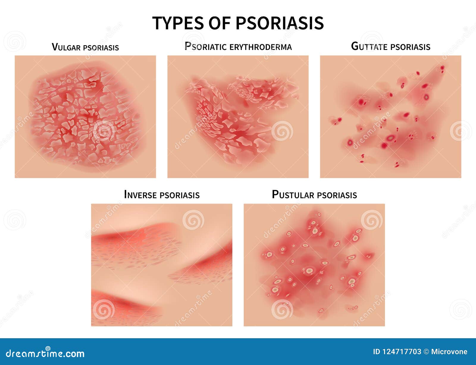 psoriasis types. skin hives, derma diseases. closeup medical  