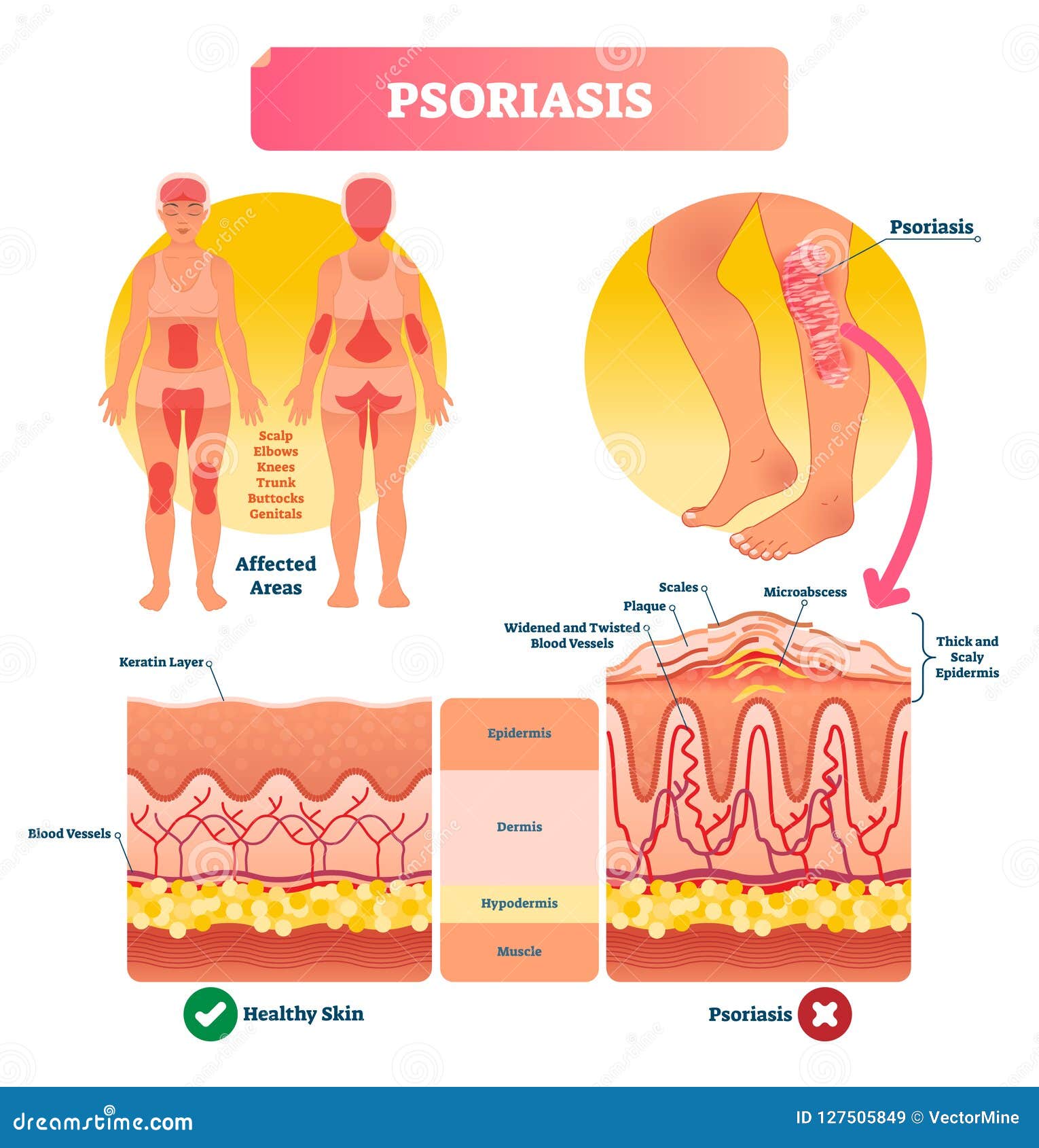 psoriasis  . skin disease and illness. labeled structure.