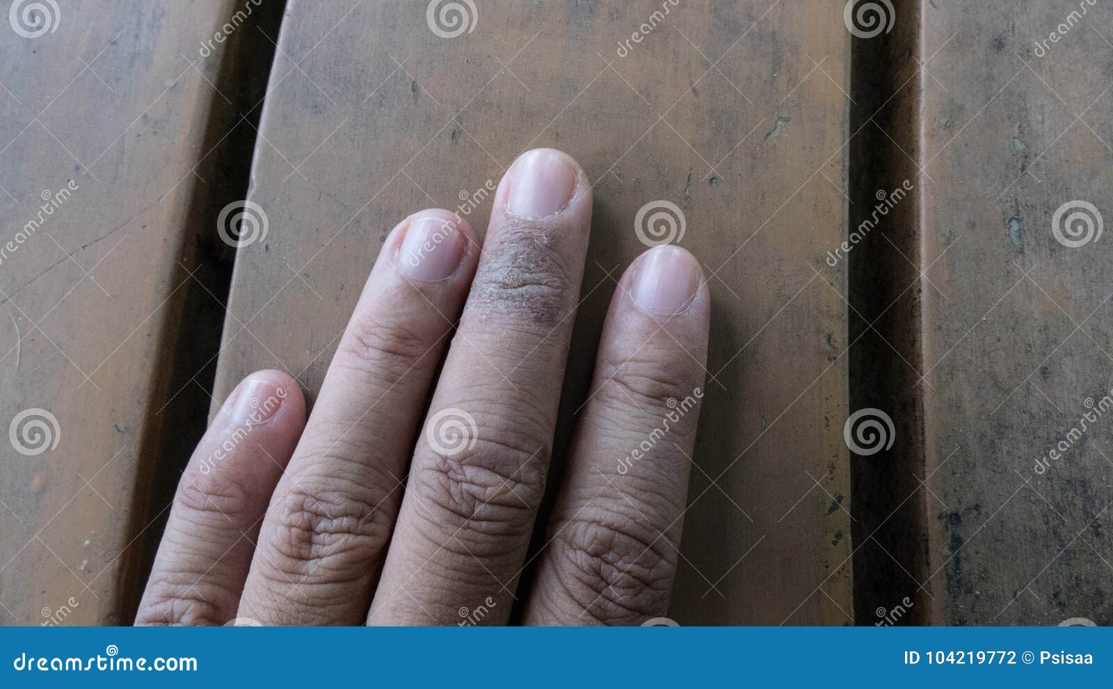 Psoriasis Vulgaris, Fungus, Eczema on Finger. Rash, Dermatological