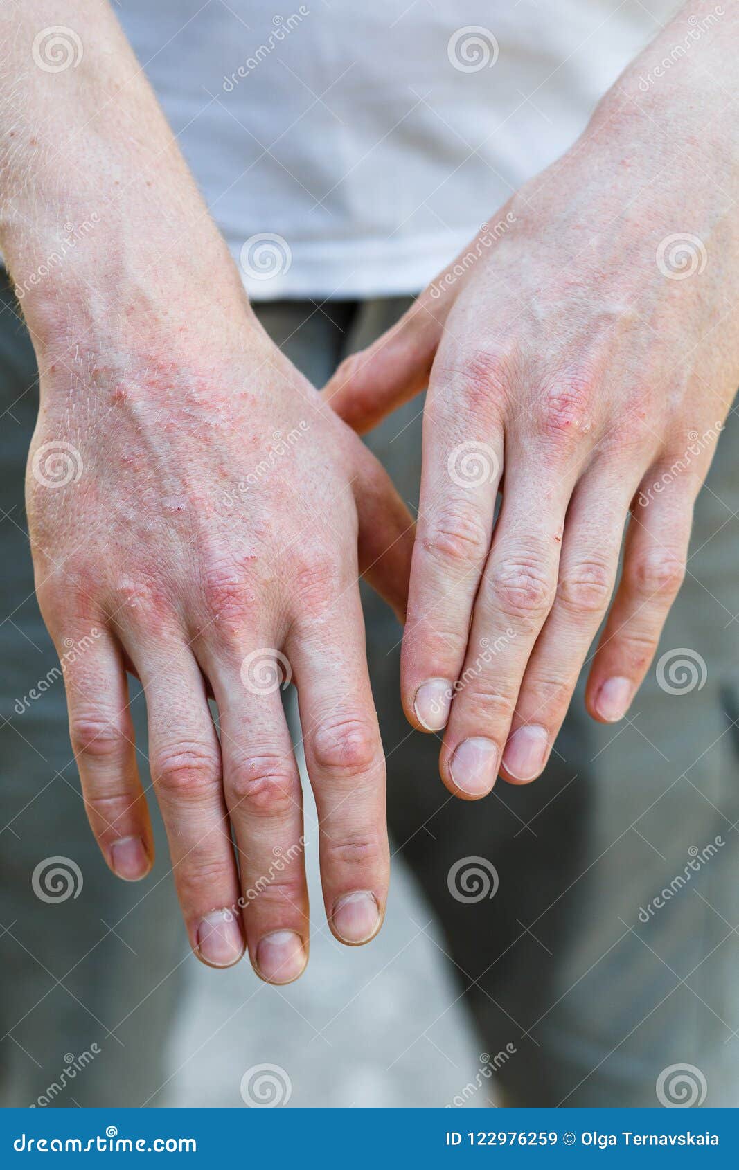 plaque psoriasis hands pictures vörös foltok jelentek meg a borjún