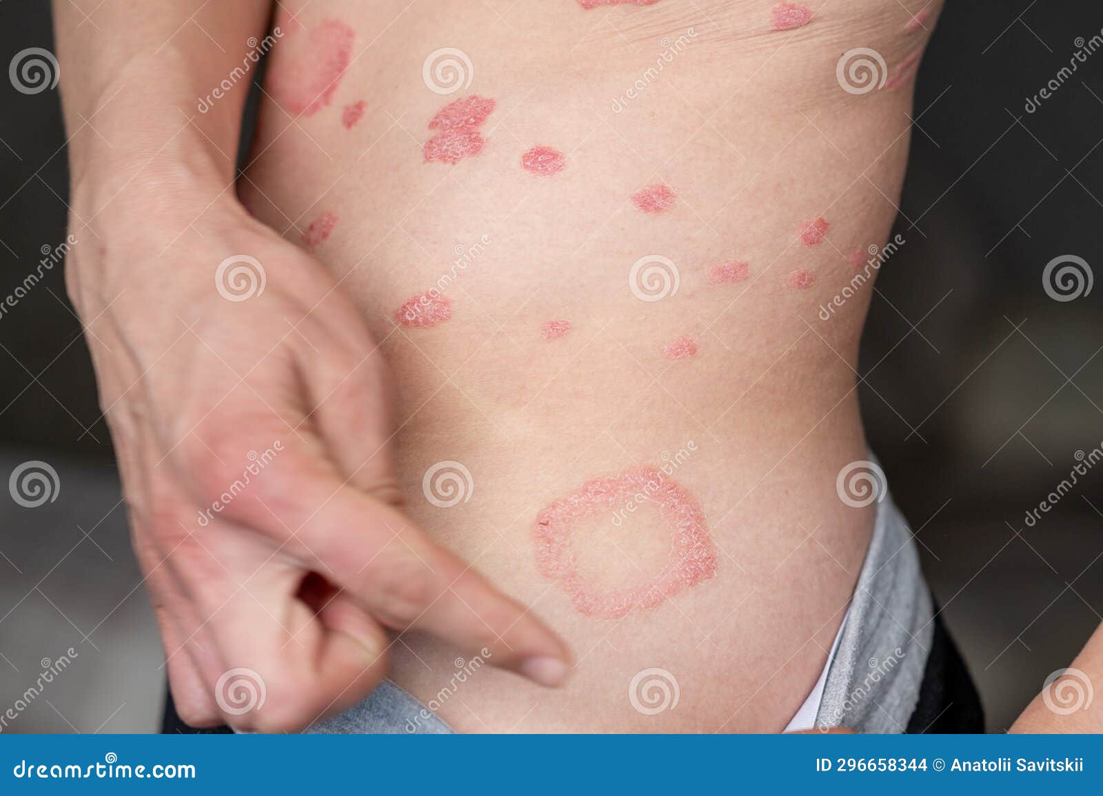 Psoriasis Vulgaris Taches De Peau Généralement Rouge Démangeaison ...