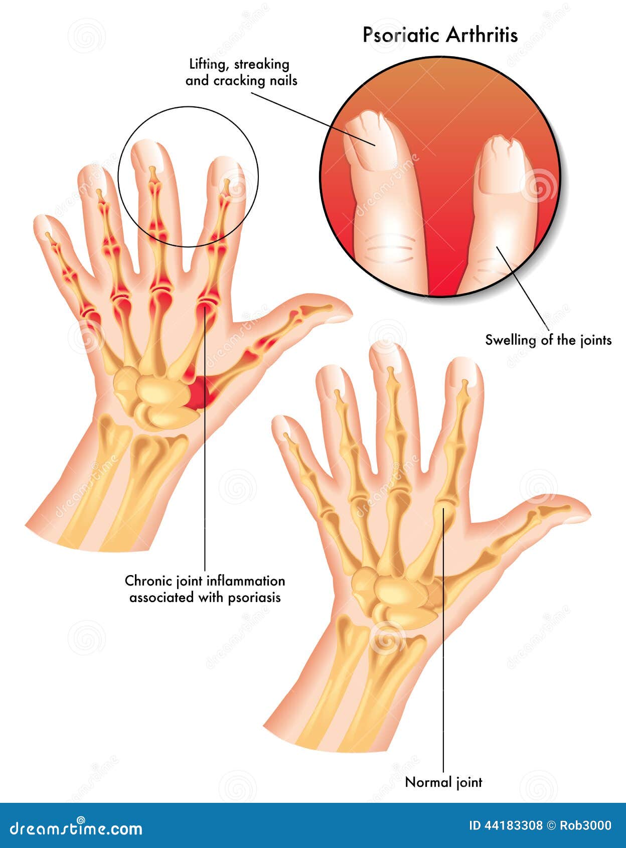 psoriatic arthritis