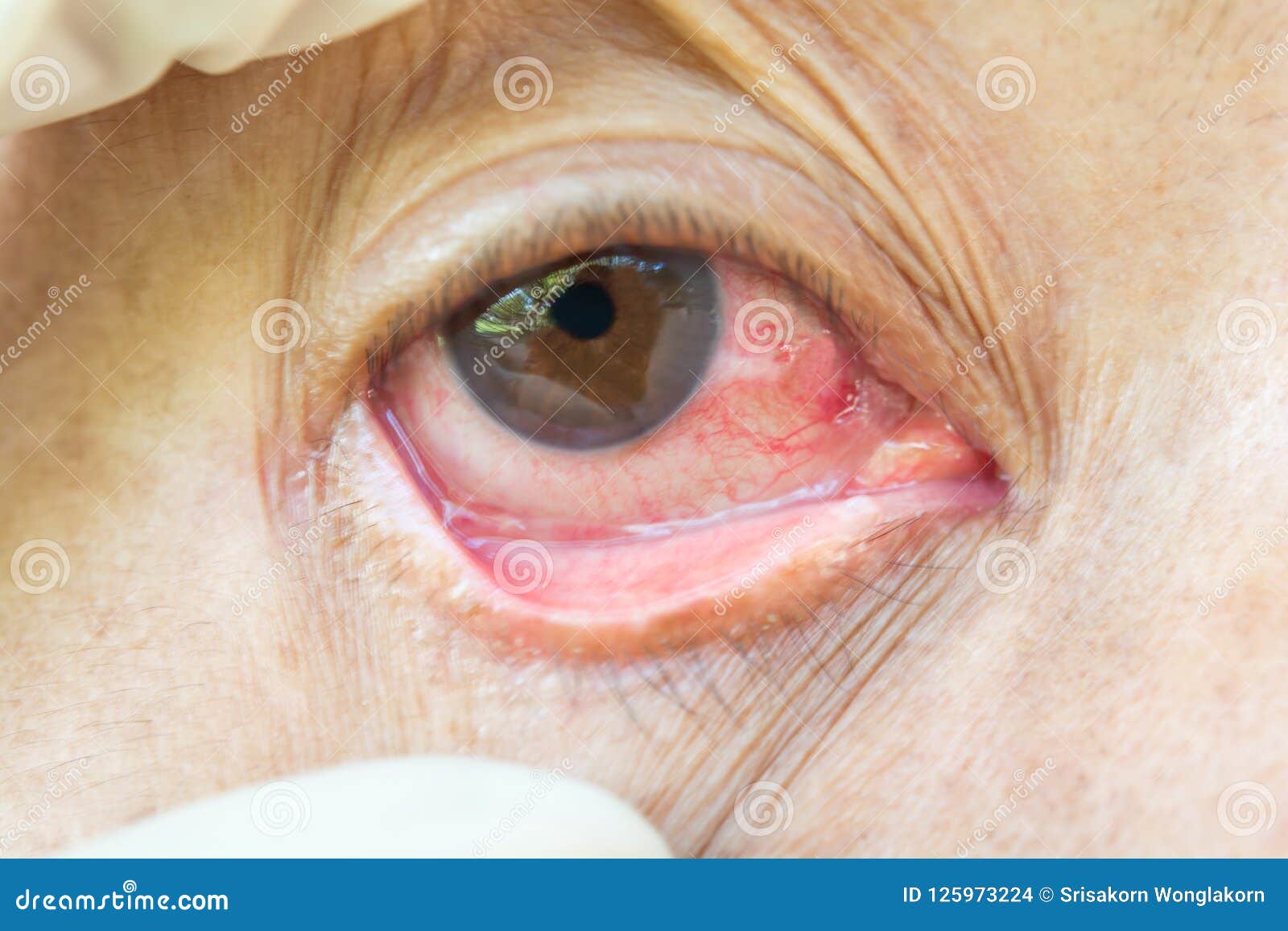 pterygium in eye