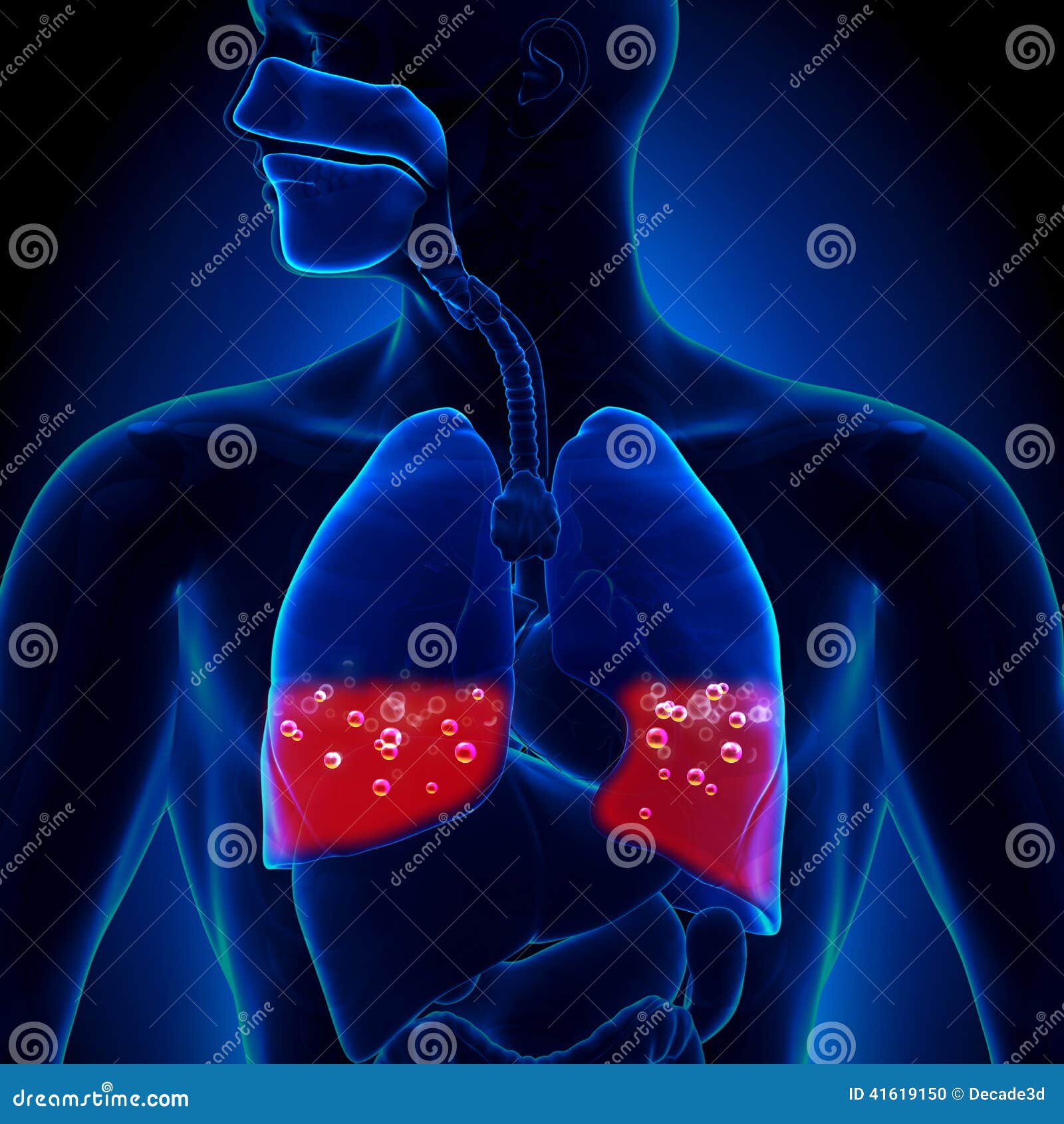 pulmonary edema - blood in lungs