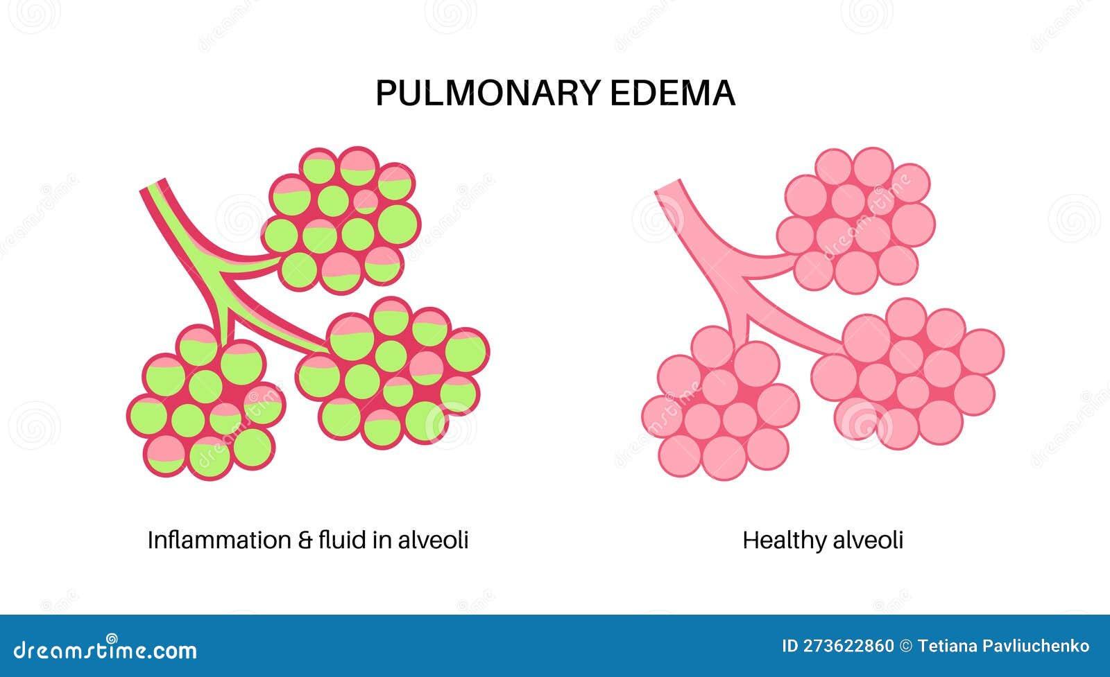 Pulmonary edema disease stock vector. Illustration of anatomy 273622860