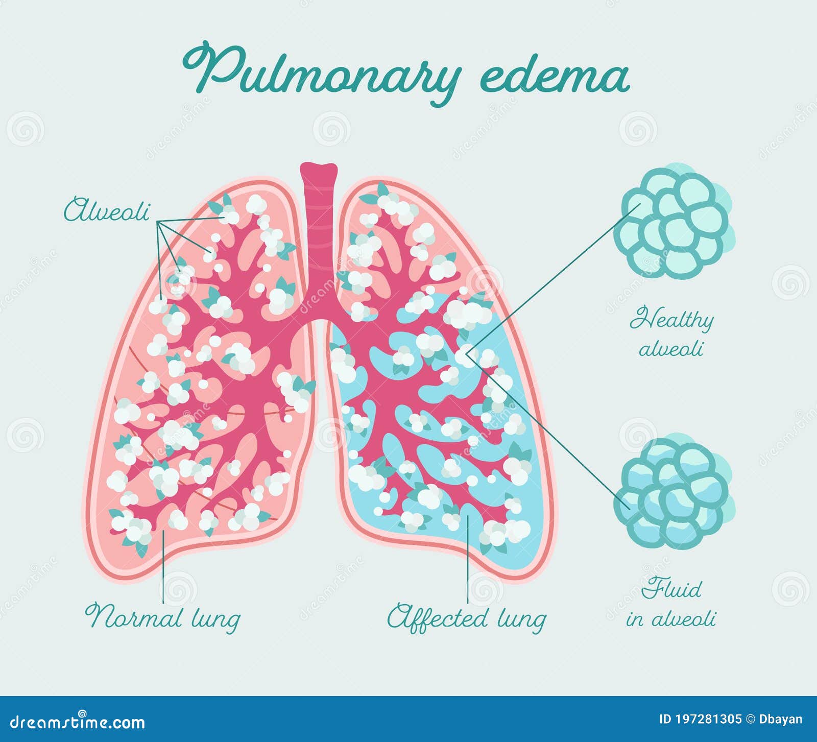 pulmonary edem pulmonary edem