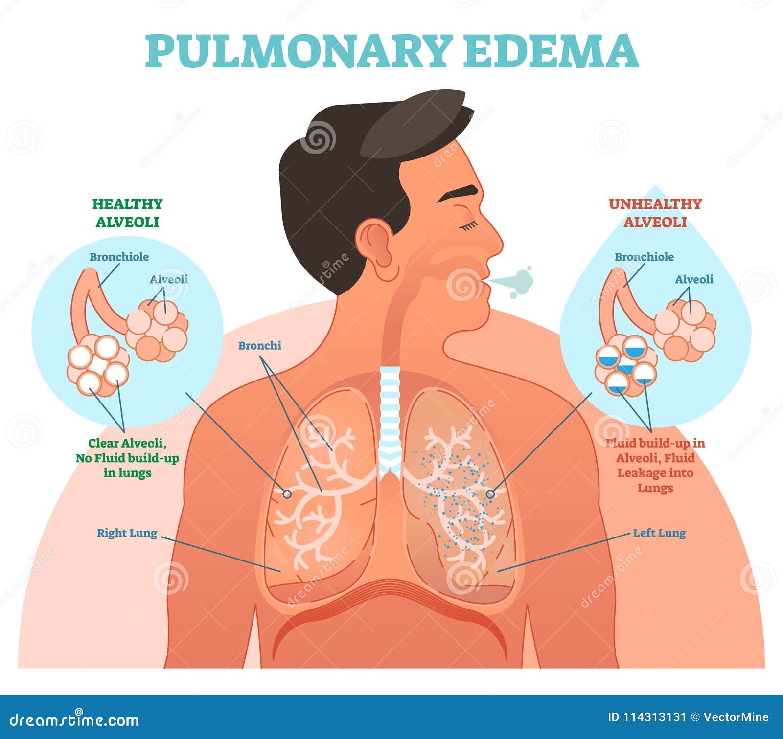 pulmonary edema, lung problem   diagram