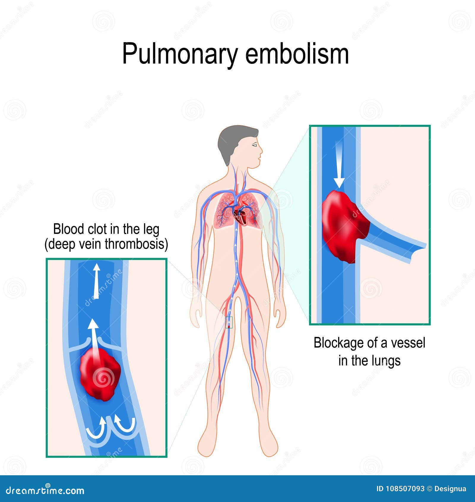 pulmonary embolism. human silhouette with highlighted circulatory system.