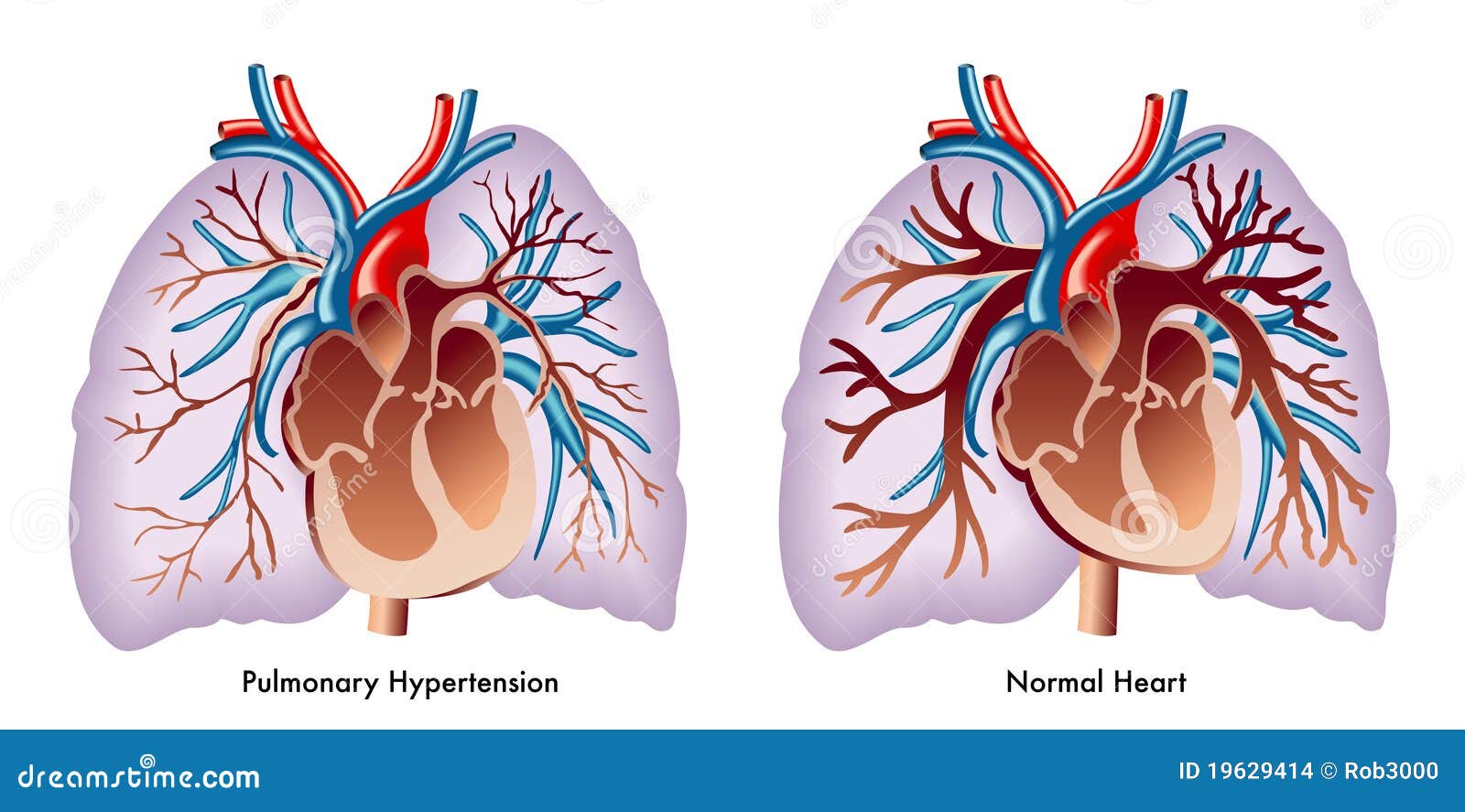 pulmonary hypertension