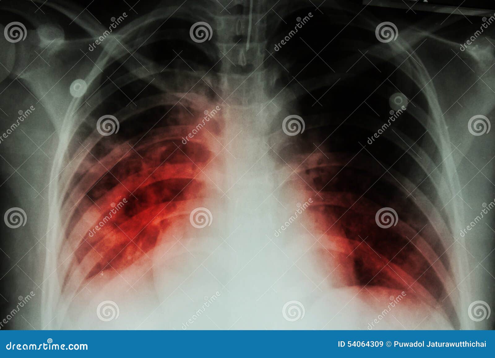pulmonary tuberculosis ( tb ) : chest x-ray show alveolar infiltration at both lung due to mycobacterium tuberculosis infectionp