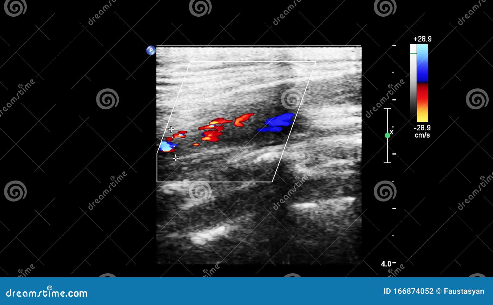 doppler ultrasound doppler ultrasound