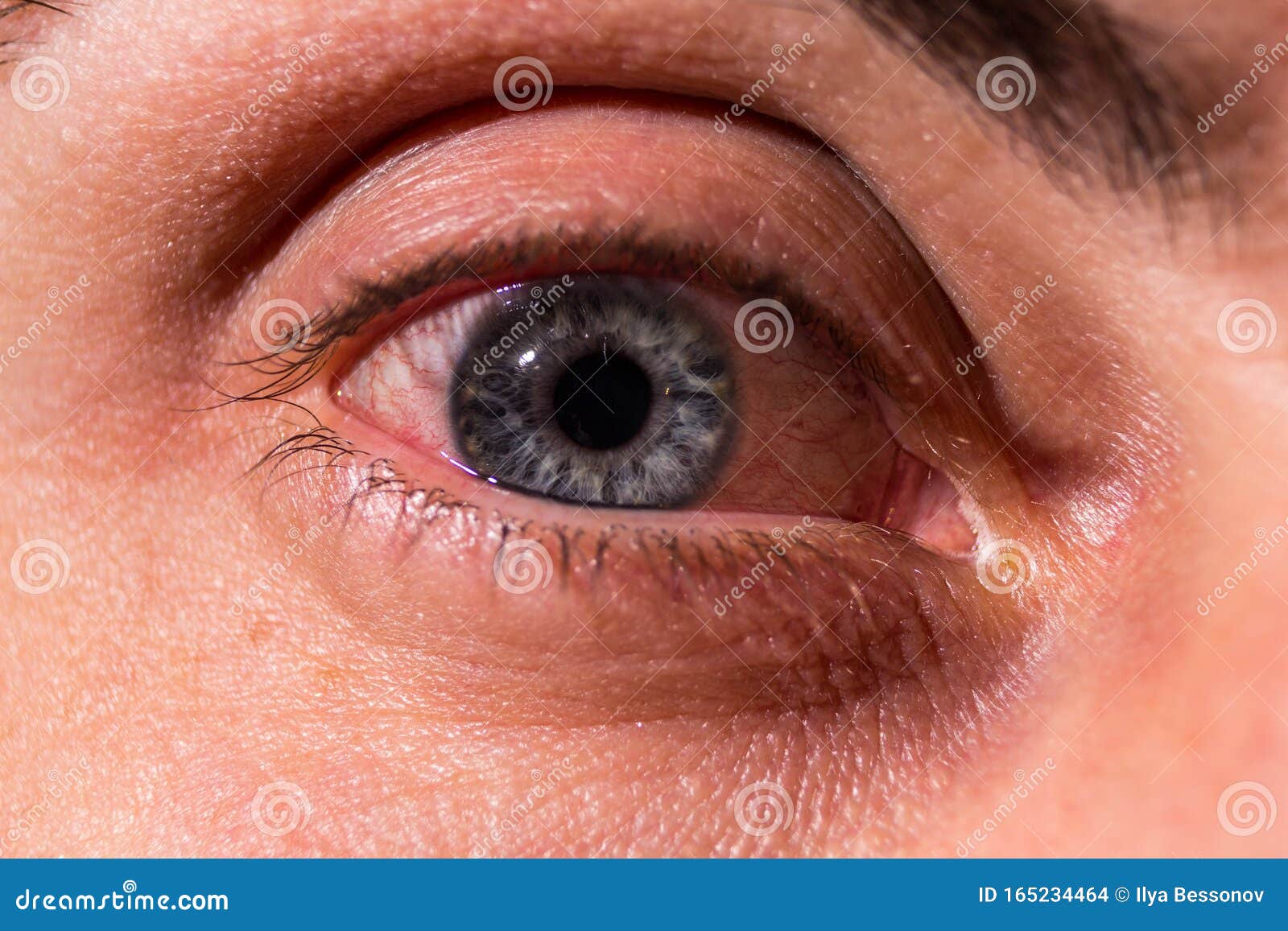 Pus Arises from an Infected Eye. Near Stock Photo Image of feet