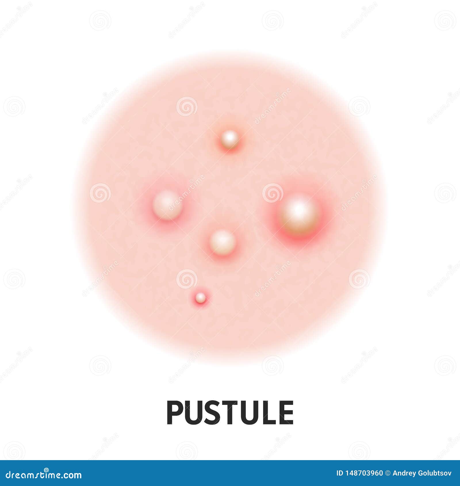 pustule skin acne type  icon. skin disease acne pustules pimples type, face pore comedones