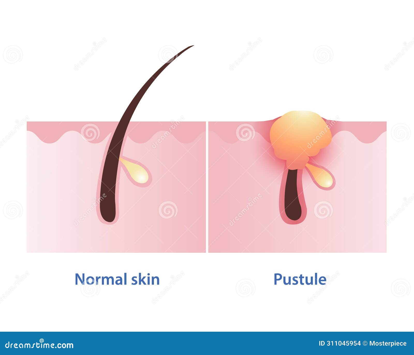 pustule, type of inflammatory acne develop from papule  on white background.