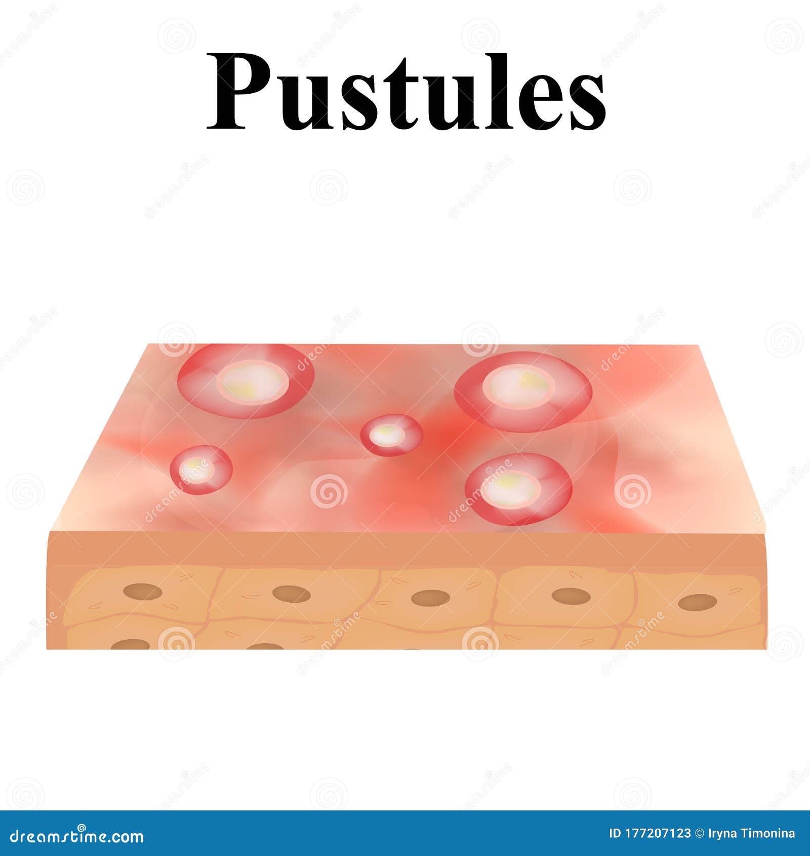 pustules. acne on the skin. dermatological and cosmetic diseases on the skin of the face acne. infographics. 